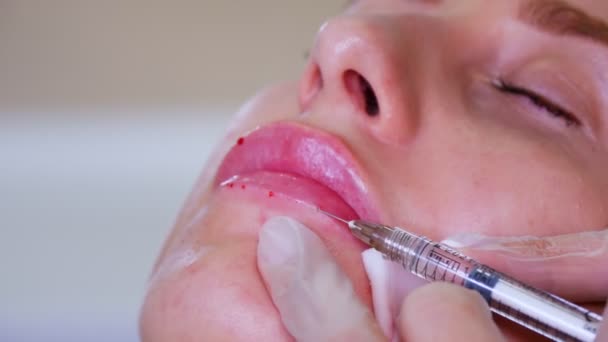 Lip augmentation procedure. close-up, female face. Surgeon, in medical gloves, pierces womans lip with a syringe and slowly injects hyaluronic acid. beauty injections. Plastic surgery. — Stock Video