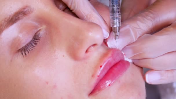 Läppförstoringsförfarande. Närbild, kvinnligt ansikte. Kirurg, i medicinska handskar, genomborrar kvinnan läppen med en spruta och injicerar långsamt hyaluronsyra. Skönhetsinjektioner. Plastkirurgi. — Stockvideo