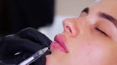Yakın plan, kadın yüzü. Cerrah, tıbbi eldivenlerle kadının dudağına şırınga batırır ve yavaşça hyaluronik asit enjekte eder. Dudak büyütme prosedürü. Güzellik iğneleri. Estetik ameliyat.