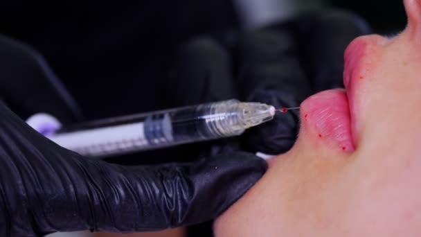 Close-up, lábios femininos.. O cirurgião, em luvas médicas, perfura o lábio das mulheres com uma seringa e injeta lentamente o ácido hialurônico. procedimento de aumento labial. injecções de beleza. Cirurgia plástica. — Vídeo de Stock