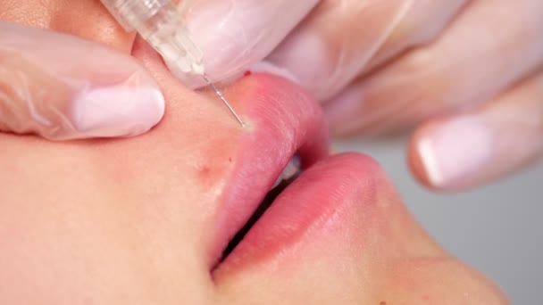 Primer plano, labios femeninos. Cirujano, en guantes médicos, inyecta cuidadosa y lentamente ácido hialurónico en los labios de las mujeres con una jeringa. procedimiento de aumento de labios. inyecciones de belleza. Cirugía plástica. — Vídeos de Stock