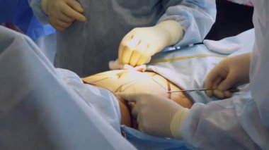 Yakın plan. Abdominal yağ aldırma. Ameliyat. Cerrah yağı özel bir tüple pompalar. Hastanede ameliyathane ve yoğun bakım