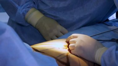 Yakın plan. Abdominal yağ aldırma. Ameliyat. Cerrah yağı özel bir tüple pompalar. Hastanede ameliyathane ve yoğun bakım