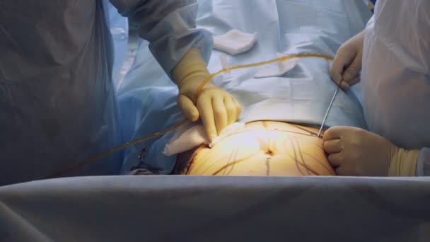 Zbliżenie. liposukcja brzucha. operacja. Chirurg wypompowywał tłuszcz przez specjalną rurkę. sala operacyjna i intensywna opieka w szpitalu — Wideo stockowe