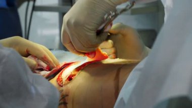 Yakın plan. Cerrah hastaların karnına bir kesik atar, karın bölgesinin bir kısmını kalın bir yağ tabakasıyla keser. Ameliyat, abdominal liposuction ameliyathanede, hastanede.