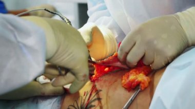 Yakın plan. Cerrah, yoğun bir yağ tabakasıyla karın bölgesinin bir kısmını hastadan ayırıyor. Ameliyat, abdominal liposuction ameliyathanede, hastanede.