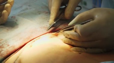 Estetik ameliyat. Yakın plan. Cerrah abdominal liposuction 'dan sonra hastaların karnına büyük bir kesik atar..