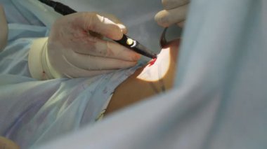 Yakın plan. Cerrah göğüs implantı için bölgeyi temizler. Göğüs büyütme estetiği. Mammaplasti. Göğüs kanseri