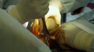 Yakın plan. Cerrah, tıbbi eldivenlerle silikon implantı iyot çözeltisiyle tedavi ediyor ve göğüs derisinin altına itiyor. Göğüs büyütme estetiği. Mamaplasti..