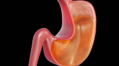 A 3d rendering of gastric balloon, or an intragastric balloon, is a non-surgical, temporary medical device used to promote weight loss in patients with obesity or significant overweight.