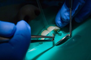 Diş hekiminde ön dişler incelenir ve tedavi edilir. Kesici dişler takılır. Yakın plan, beyaz temiz dişler takılır..