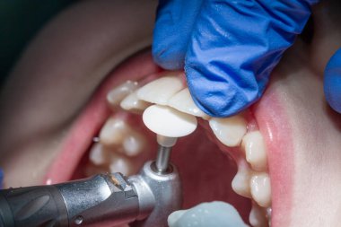 Ön diş tedavisi, ön dişler, diş muayenesi..