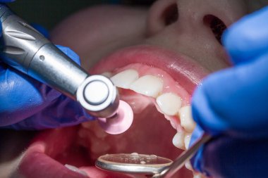 Ön diş tedavisi, ön dişler, diş muayenesi..