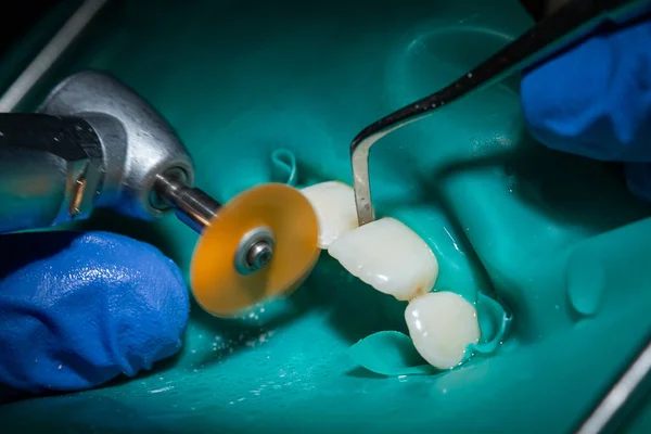 Inspection Treatment Anterior Teeth Dentist Cofferdam Put Incisors Taken Close — Stock Photo, Image