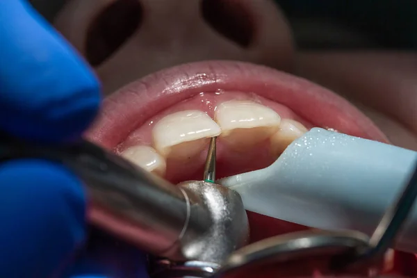 Front Teeth Treatment Caries Incisors Dental Examination — Stock Photo, Image