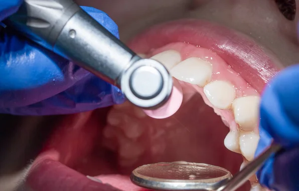 Огляд Лікування Передніх Зубів Стоматолога Кавердрам Наносять Різці Взяті Впритул — стокове фото