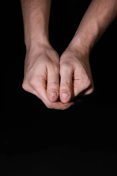 Man hand nail damage. Bitten nails. Men manicure. Nail plate problems. Man hands . Isolated on a white background.