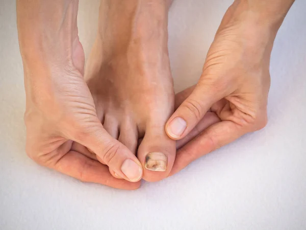 Moretones en el dedo del pie. Problemas en los pies . — Foto de Stock