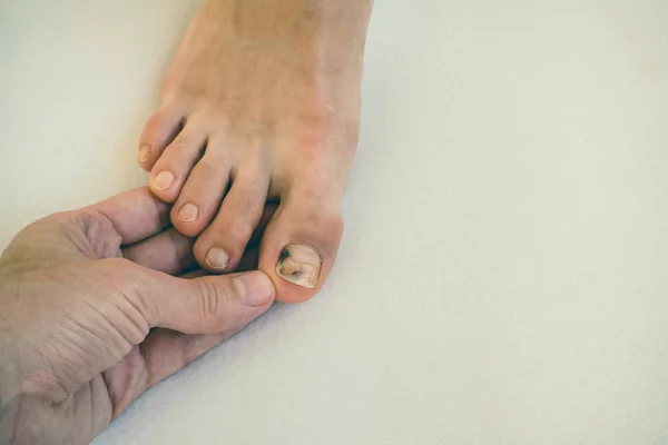 Bruise op de nagel, close-up. Pijnlijke blauwe plekken op haar teennagels. — Stockfoto