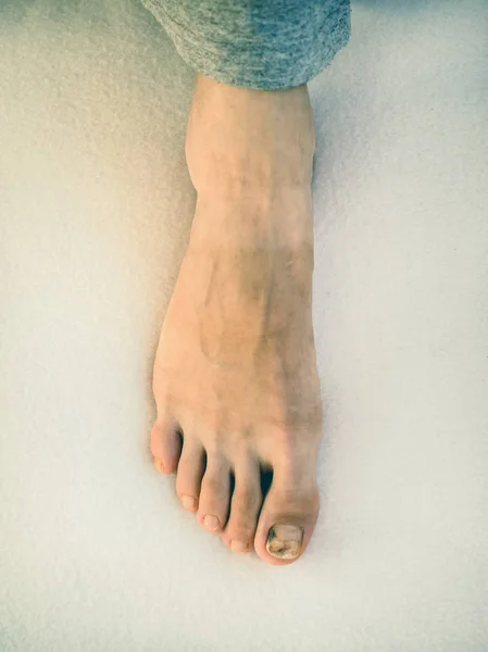 Un livido sull'unghia, primo piano. Lividi dolorosi sulle unghie dei piedi . — Foto Stock