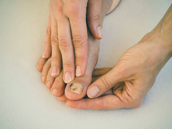 Bruise on the nail, close-up. Painful bruising on her toenails. — Stock Photo, Image