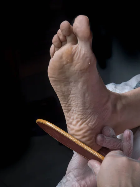 Maíz doloroso a pie. Tratamiento de los pies en cosmetología. De cerca. . — Foto de Stock