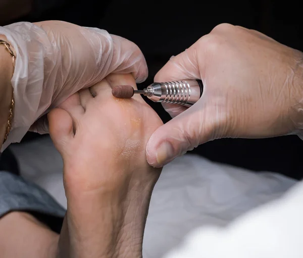 Feche o Calluses. Milho doloroso a pé. Tratamento de calos nos pés . — Fotografia de Stock