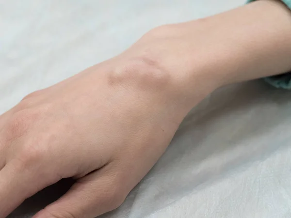 Büyük kist (hygroma), sıvı dolu yumru eklem ile ilişkili