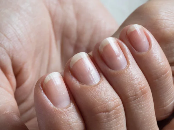 Uñas dañadas después del esmalte de gel. De cerca. . — Foto de Stock