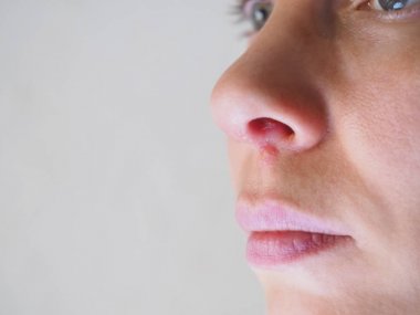 Bir kadının burnunun dibinde ki uçuk. Yakın çekim