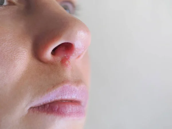 鼻の下のヘルペスクローズアップ — ストック写真