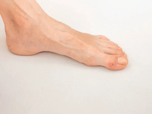 Parmağında nasır olan bir ayak.. — Stok fotoğraf