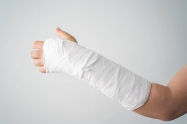 Beyaz alçı bandajlı kırık bir kol yaralı parmaklarını ısıtıyor.