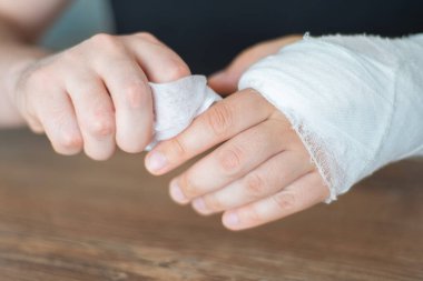 Kırık kemik. Kırık bir kolu alçıtaşıyla peçeteyle yıkayan bir adam. Yaralanma için zor bakım