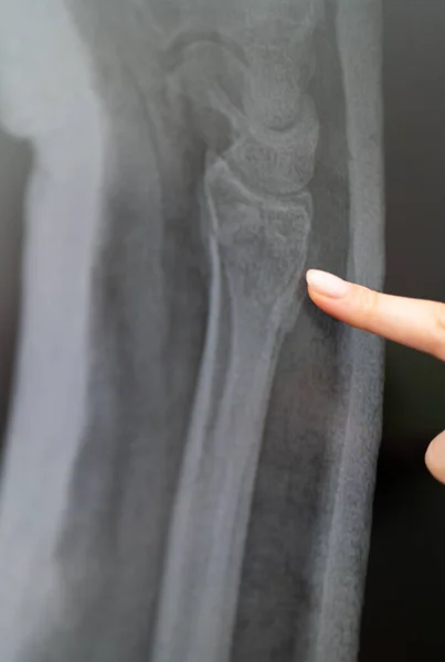 Radiografía del hueso del brazo. Radiólogo examina la grieta — Foto de Stock