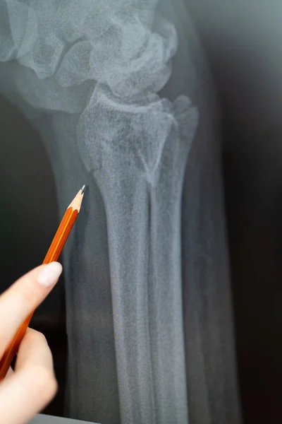 Radiografía de un brazo roto en un yeso. El médico le muestra al paciente la ubicación de la lesión. Una imagen de un esqueleto humano — Foto de Stock