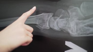 Kırık radyal kemiğin yerinden oynadığı röntgenler. Doktor yaralı kemiği inceliyor. Radyolog klinikte teşhis koyuyor.