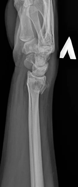 Una radiografía de un hueso humano fracturado en movimiento. Anatomía del esqueleto — Foto de Stock