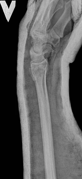 Hand X-ray after bone repositioning. Picture of a broken arm in plaster after a trauma surgeons procedure