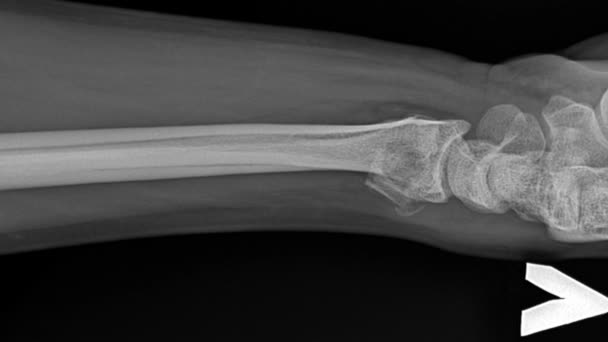 骨折的人类骨头在运动中的X光照片骷髅解剖 — 图库视频影像
