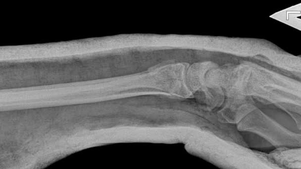 Prześwietlenie dłoni po przemieszczeniu kości. Zdjęcie złamanej ręki w gipsie po zabiegu chirurgicznym — Wideo stockowe