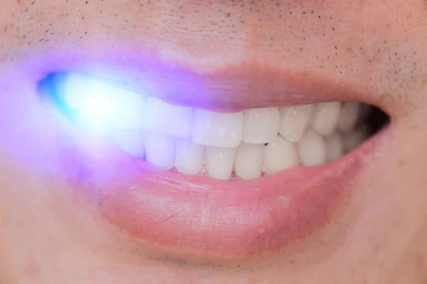 Ugly smile dental problem. Teeth Injuries or Teeth Breaking in M — Stock Photo, Image