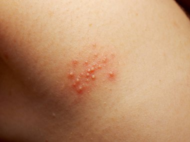 Close up of girl has rash and other nonspecific skin eruption on her shoulders. May be caused by dirt, virus, mold, or bacteria. The doctor is currently diagnosed clipart