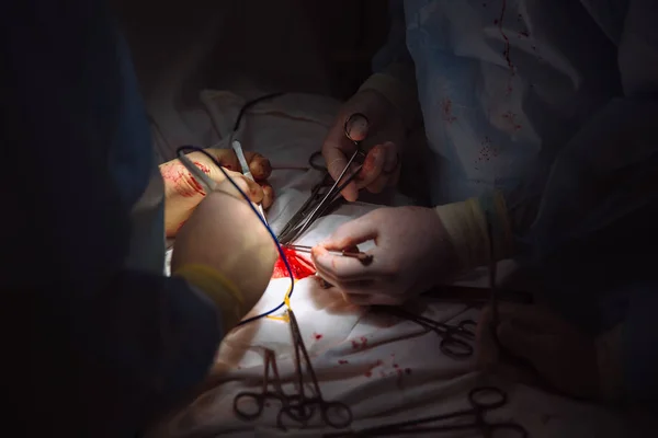 Mãos fechadas, equipe de doutores durante a cirurgia, instrumentos cirúrgicos em uma mesa médica em uma clínica. Tesoura estéril de metal, braçadeira, agulha cirúrgica na mesa ou na mão do médico. Conceito de saúde . — Fotografia de Stock