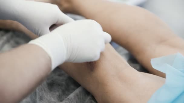 Gros plan mains de phlébologue dans les gants désinfecter la jambe du patient avec des varices avant la procédure de sclérothérapie — Video