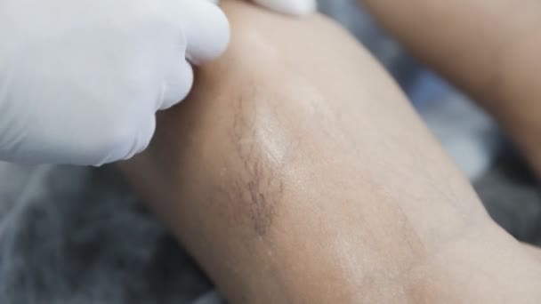 Крупним планом руки судинного хірурга в рукавичках дезінфікують ногу пацієнта з варикозним розширенням вен перед процедурою лікування — стокове відео