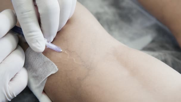 Крупным планом руки флеболога в перчатках выполняют процедуру склеротерапии на ноге пациента — стоковое видео