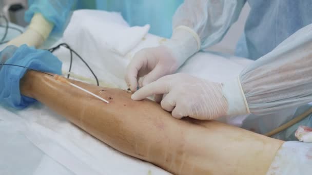 Las manos cercanas del médico con guantes estériles insertan la aguja en la pierna del paciente durante la operación de escleroterapia — Vídeo de stock