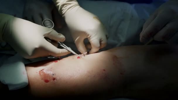 Las manos del cirujano de cerca hacen cirugía de la vena varicosa con instrumentos especiales en la pierna del paciente — Vídeo de stock