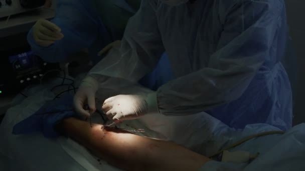 Крупним планом руки хірурга роблять операцію на варикозі спеціальними інструментами на нозі пацієнта — стокове відео